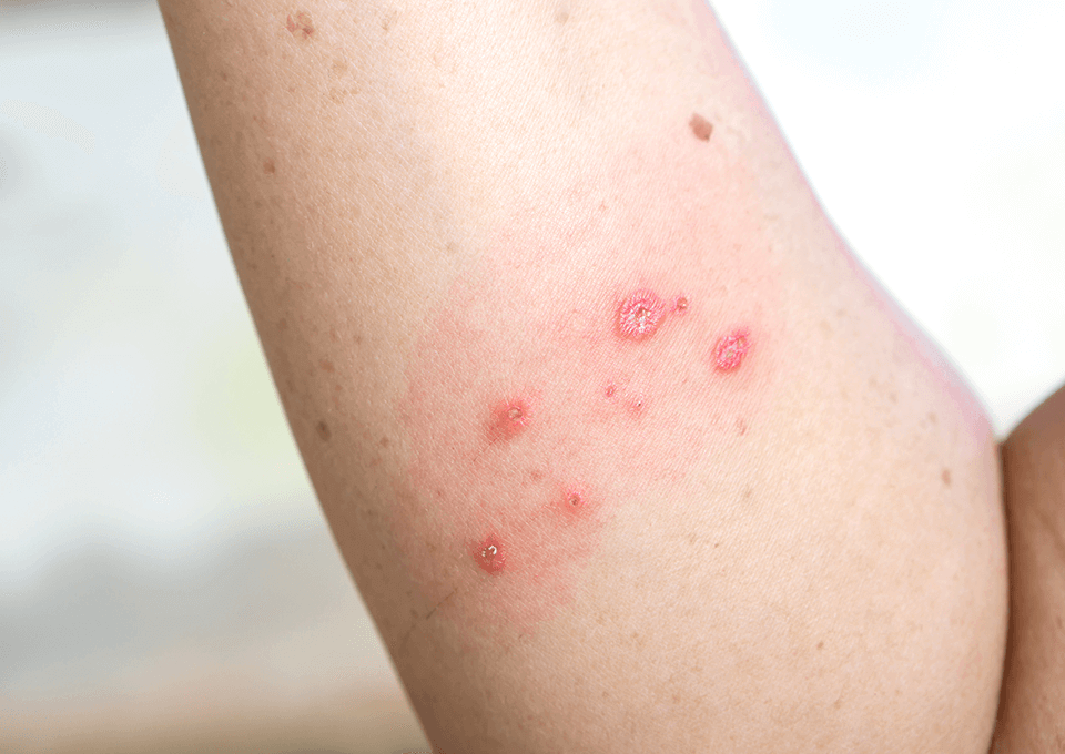 痒疹（ようしん）