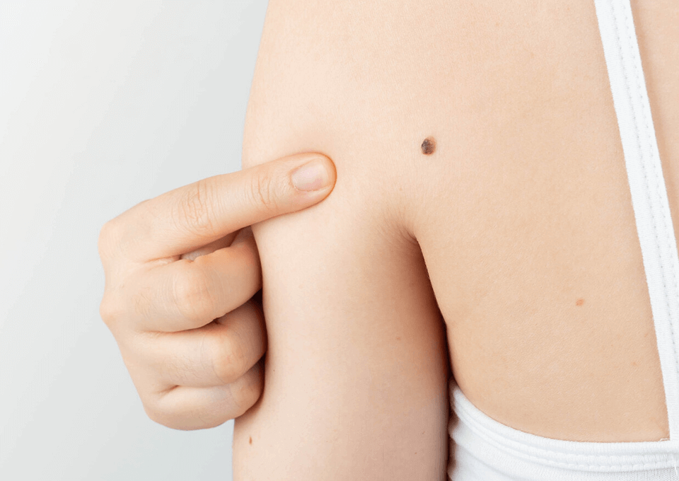 ほくろ