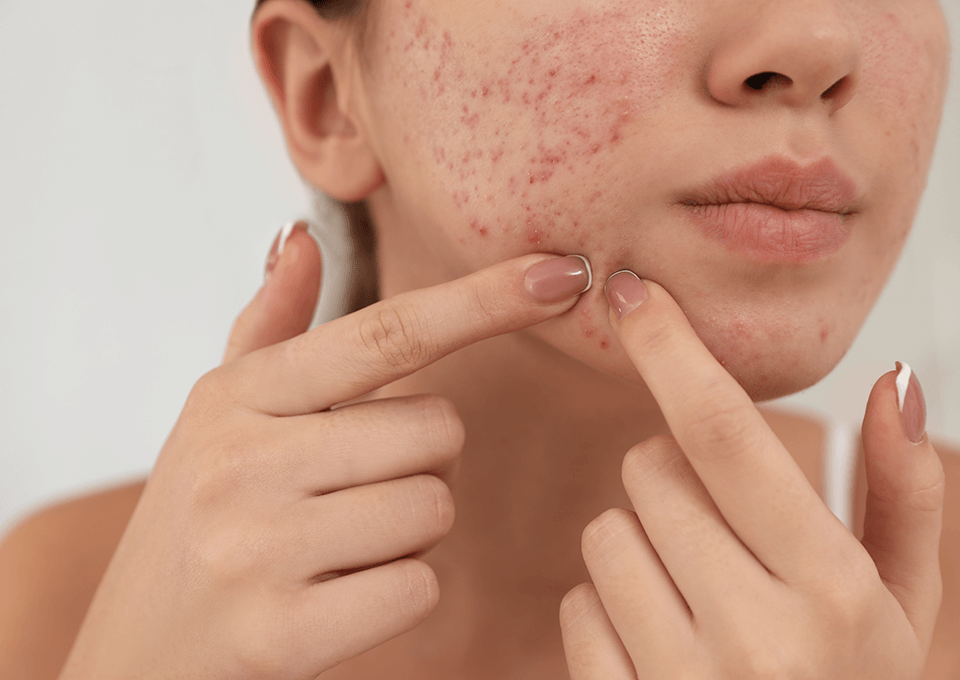 にきび（尋常性ざ瘡）