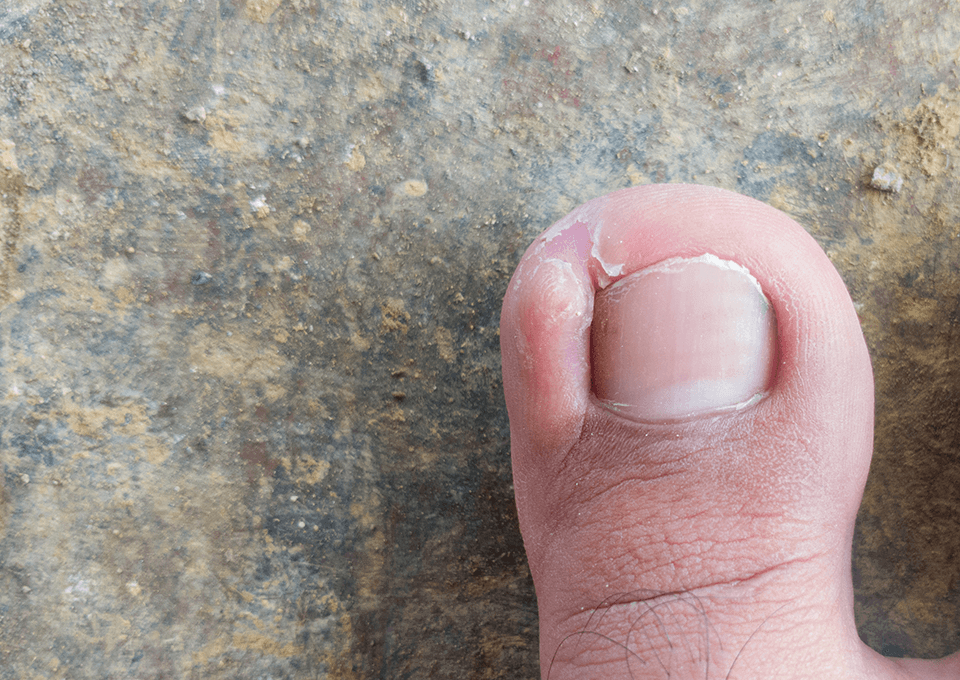 巻き爪・陥入爪